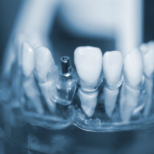 Implanty « Stomatologia - Ozimek